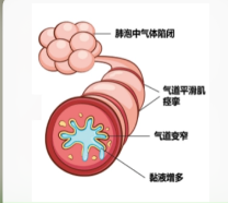 肺部神经免疫细胞相互作用推动过敏性哮喘的发展