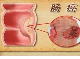 肠癌治疗后能活多久