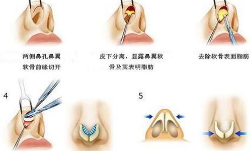 怎么把鼻头缩小？ 鼻头缩小术手术过程