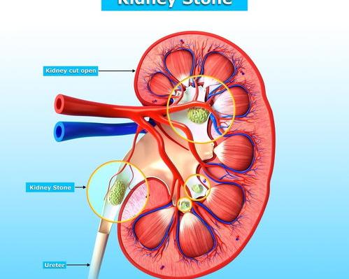 肾结石最早期症状？ 肾结石的早期症状