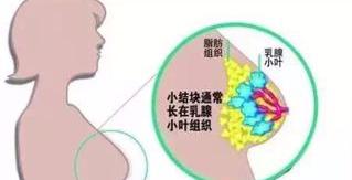 乳腺增生最好怎么治疗？ 乳腺增生需要治疗吗