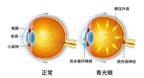 青光眼朮后多久视力恢复正常？ 青光眼与正常眼睛