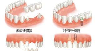 种植牙的牙冠啥样质量好？ 种植牙哪种材质好