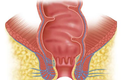 痔疮犯了怎么办，怎么消肿？ 长痔疮怎么办 有肉球怎么消肿