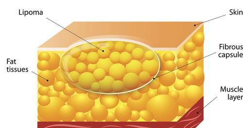 脂肪瘤能长到多大？ 脂肪瘤长什么样