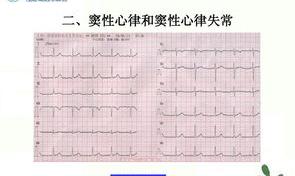 研究发现：心跳快慢与寿命长短有关，心率多少更长寿？医生告诉你 窦性心律过缓人的寿命