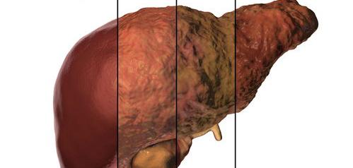 肝硬化的早期症状？ 肝硬化的早期症状