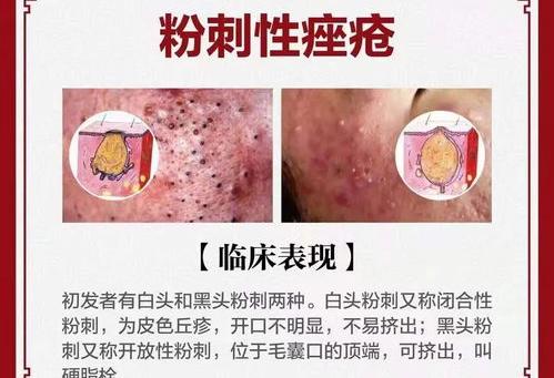 7种不同的痘痘分类及等级 痘痘类型图解