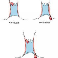 痔疮传染吗 痔疮会传染吗