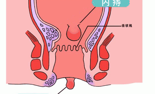 痔疮最好的治疗方法有哪些？ 怎么治疗痔疮最有效的方法