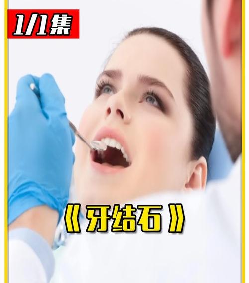 医院清除牙结石要多少钱？ 牙结石去除多少钱