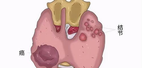 甲状腺结节ti一rads4b 是什么意思？要怎么办？ 甲状腺结节4b拖了2年