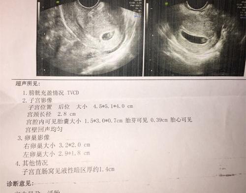 腹部肿瘤B超C丅平扫能够检查得到吗？ 腹部b超能检查出什么