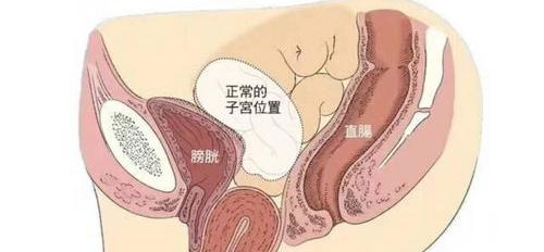 重度子宫脱垂怎么治疗？ 子宫脱垂一二三度