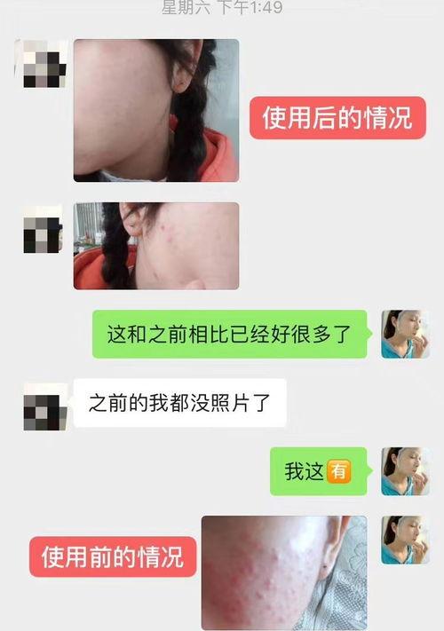 去除脸上痘印最快最有效方法？ 目前祛痘印最好最快的方法