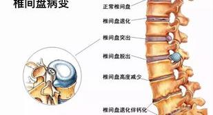 腰椎间盘突出症缓解期起床要注意什么呢？ 腰椎间盘突出怎么自愈