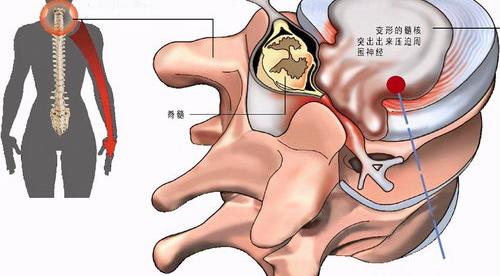 颈椎间盘突出是怎么引起的？ 颈椎病是怎么引起的