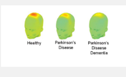 脑电波可以预测帕金森病的认知障碍